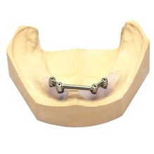 implantat